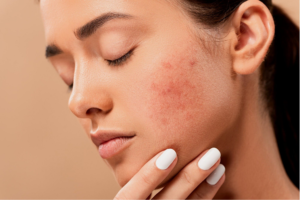 Wearing makeup with Acne